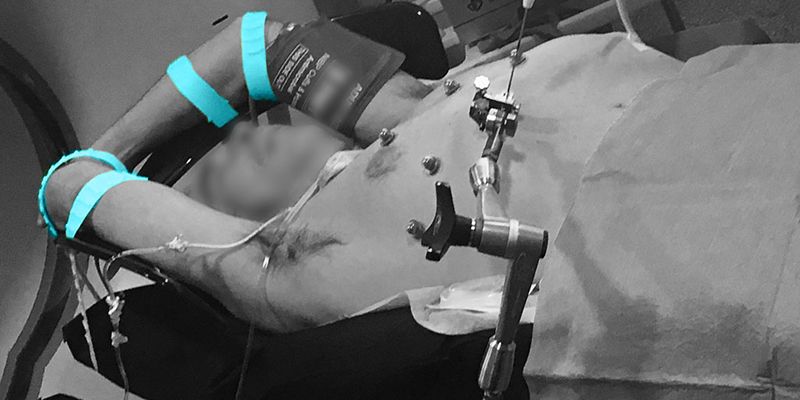 Overhead Arm Support Solution for Patient Arm Positioning